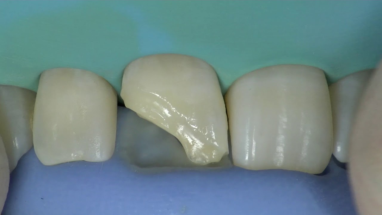 Yes, we can do it! con CLEARFIL MAJESTY ES-2