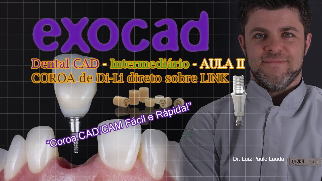 AULA EXOCAD - Como fazer uma coroa de Dissilicato direto no link - DICAS CHAVE
