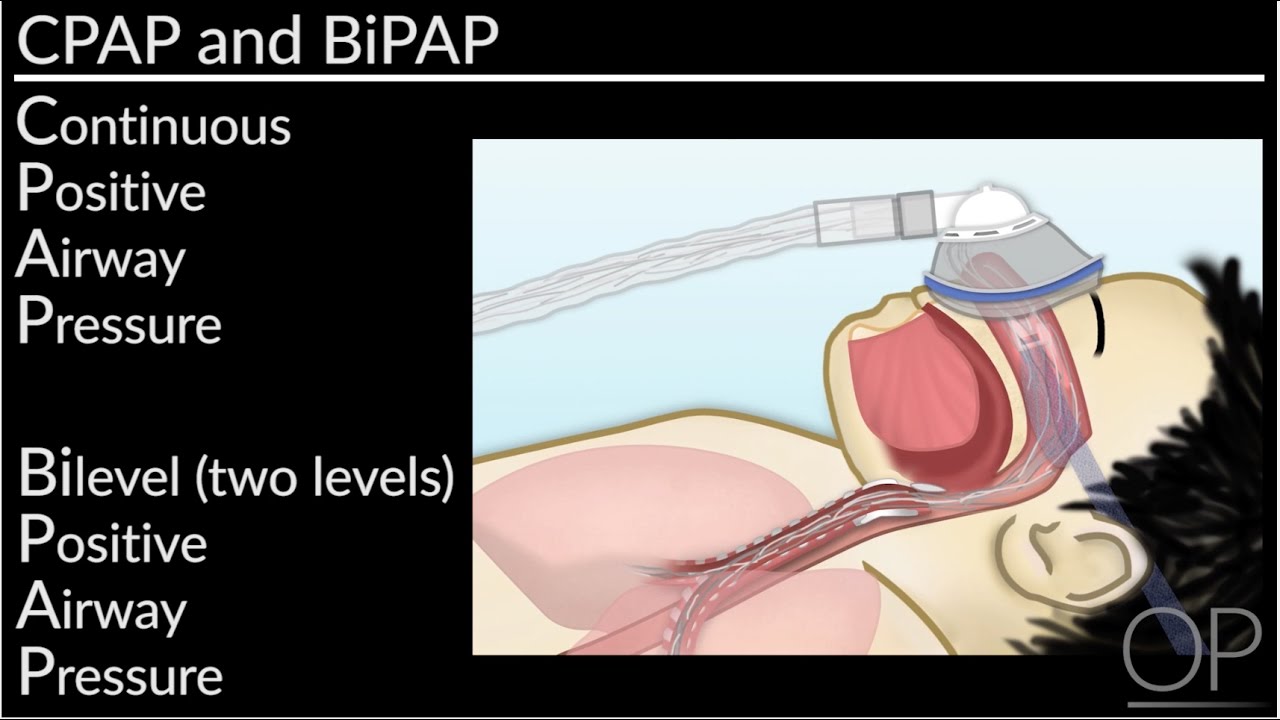Как применять СИПАП и БИПАП-терапию дома (Л. Перлман, Б. Уолш) | OPENPediatrics