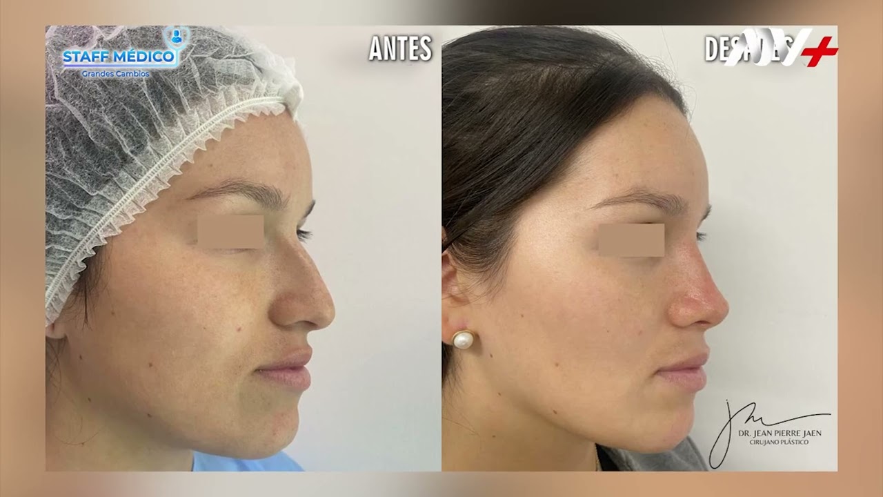 💕La Perfiloplastia: donde la belleza y la armonía se encuentran. 💫- Dr. Jean Pierre Jaen