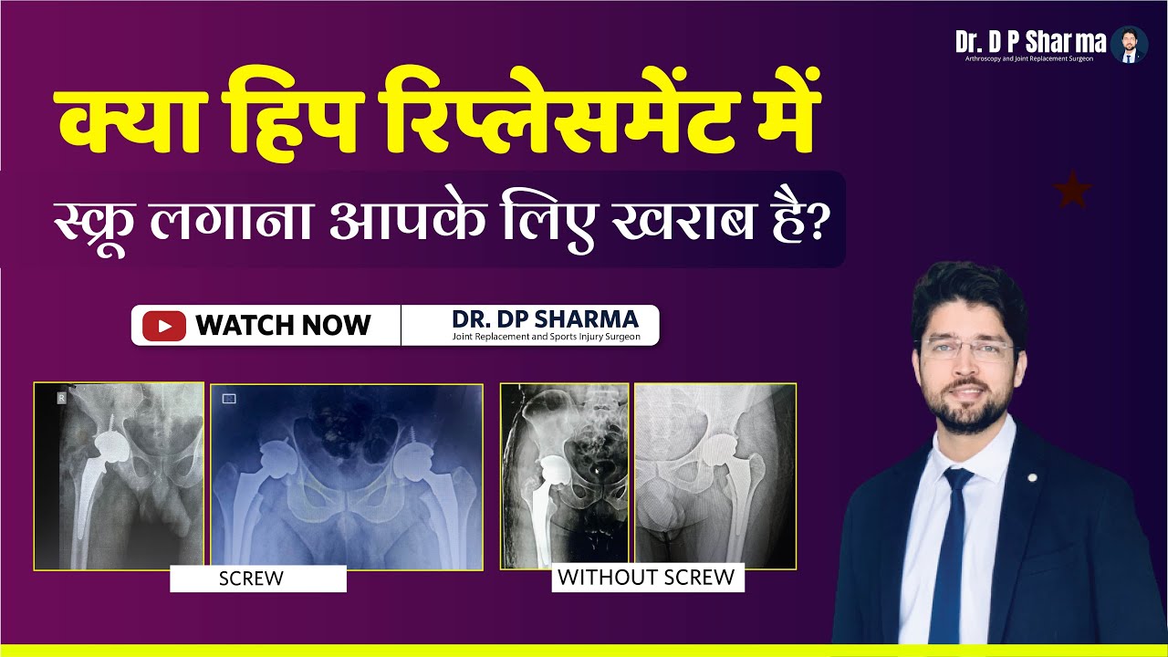 Are Screws Bad For Your THR? MIS Direct Anterior HIP Replacement In Delhi-NCR & Agra - Dr DP Sharma