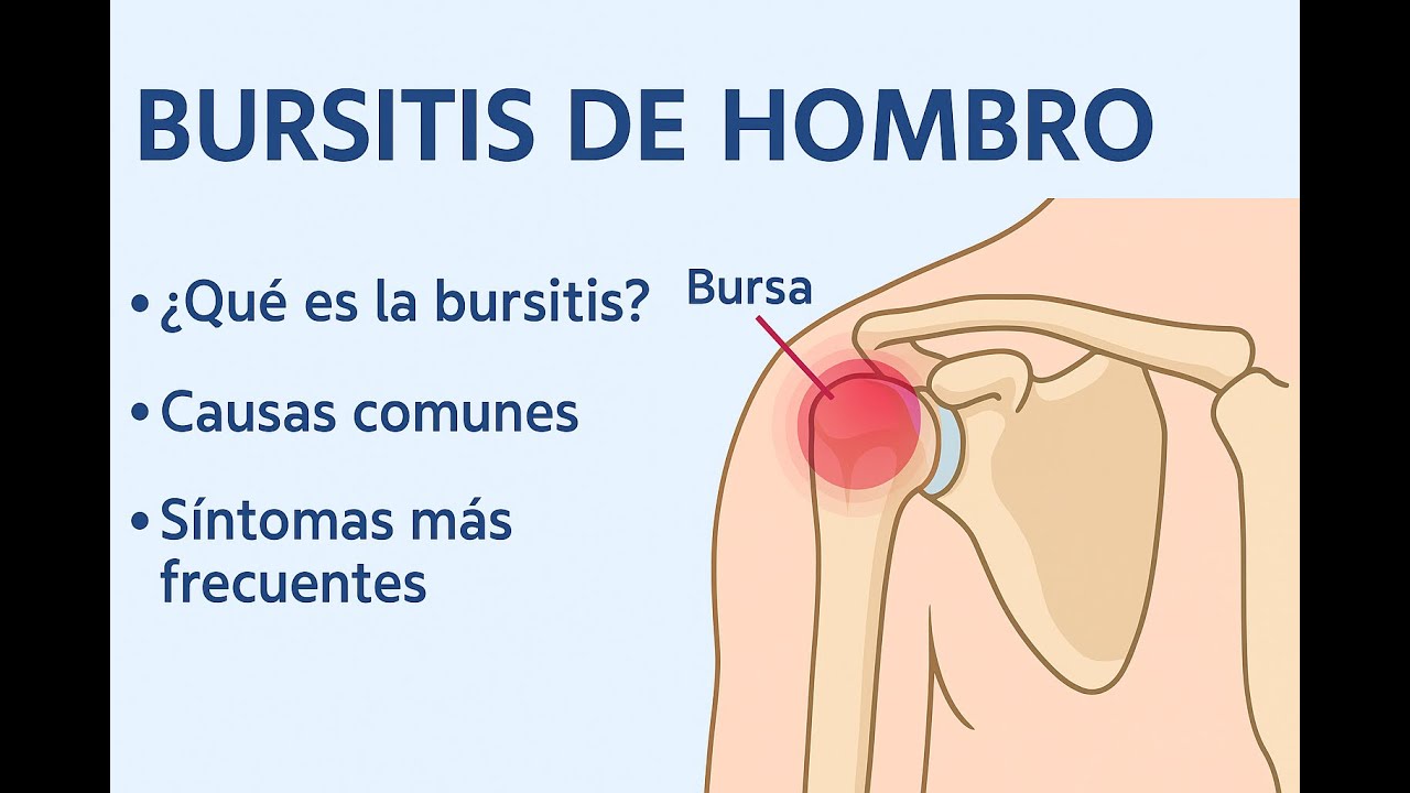EJERCICIOS PARA LA BURSITIS DE HOMBRO