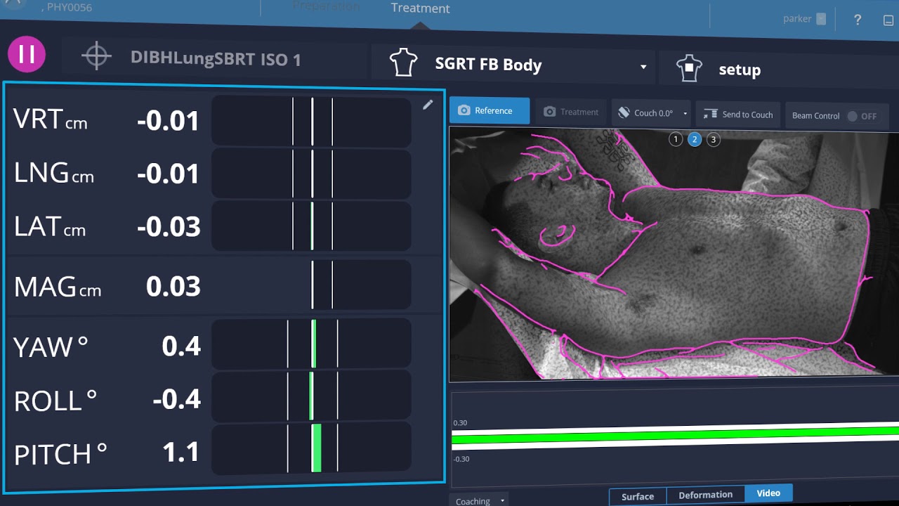 AlignRT Advance Breath Hold Overview: