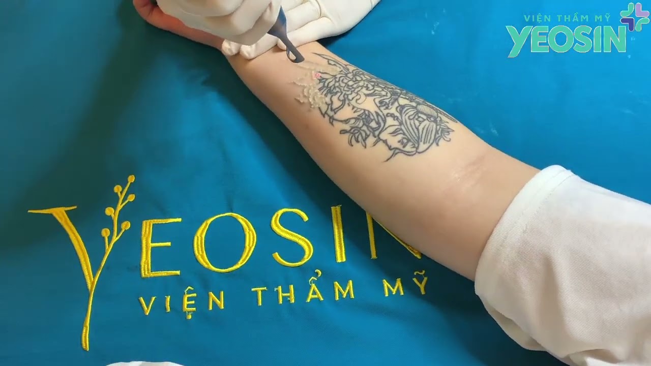 🔥 XÓA XĂM CỰC NHANH – SẠCH MỰC – KHÔNG SẸO VỚI PICOSURE PRO