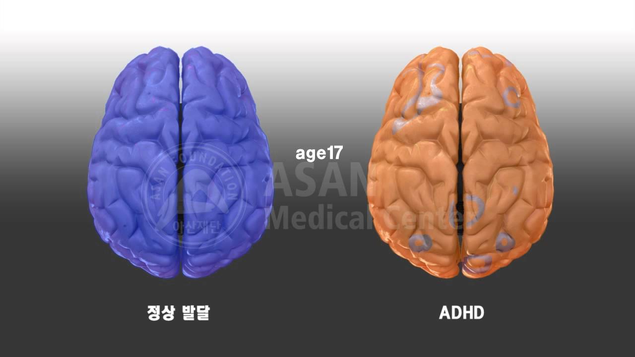 Compare normal vs ADHD brain
