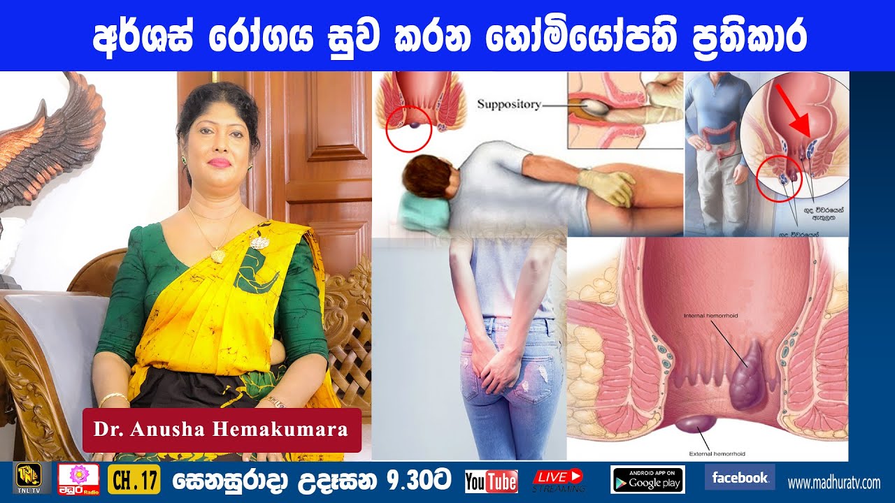 අර්ශස්  රෝගයෙන් සුවය ලබාගැනීම සදහා හෝමියෝපති ප්‍රතිකාර ක්‍රම | Dr. Anusha Hemakumara | 2022. 01. 15