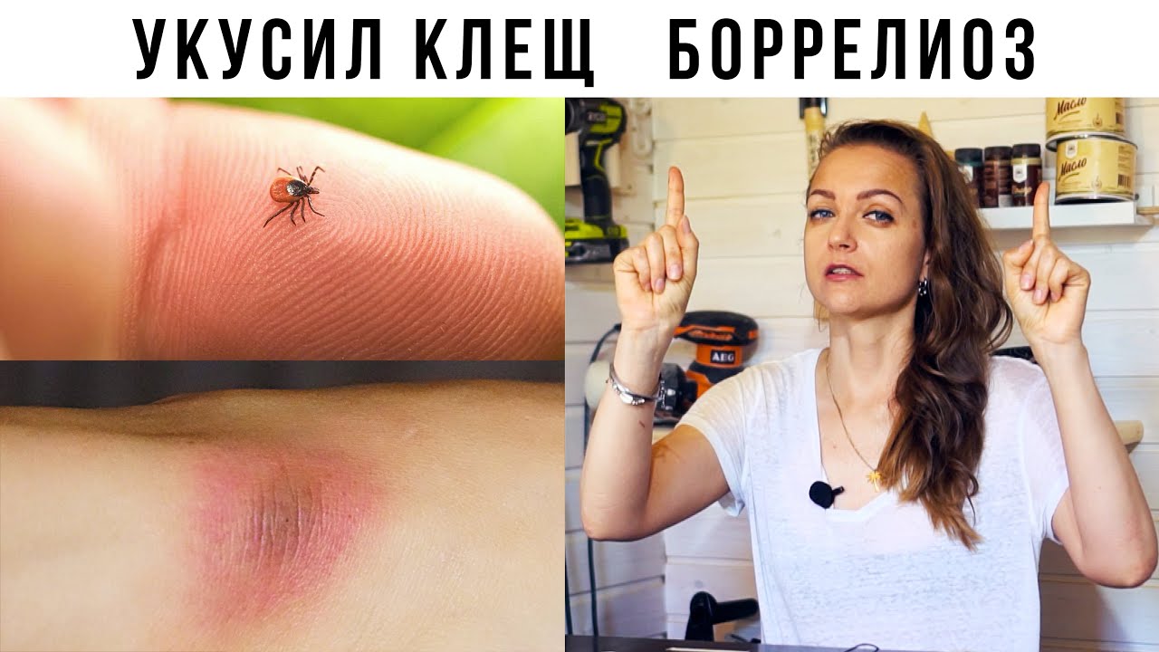 Как лечила Боррелиоз, болезнь Лайма. Симптомы, анализы, лечение.