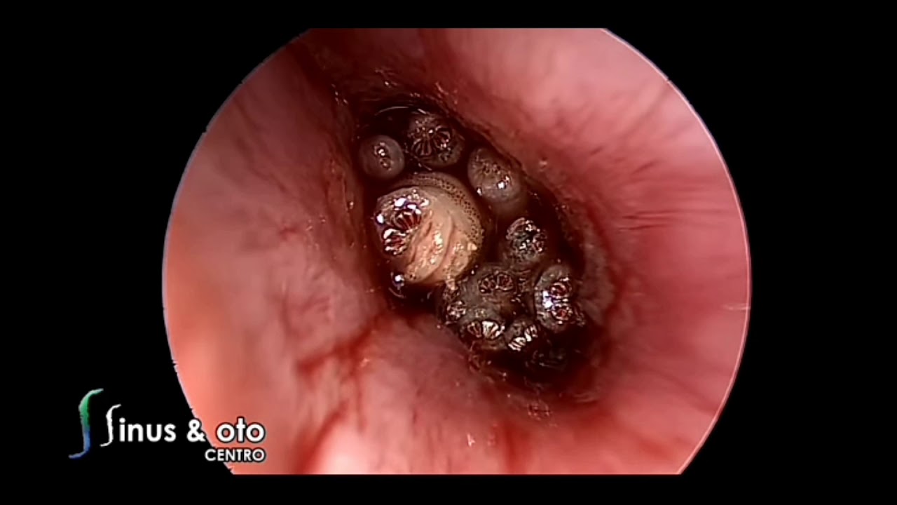 耳朵肌病 myiasis of the ears