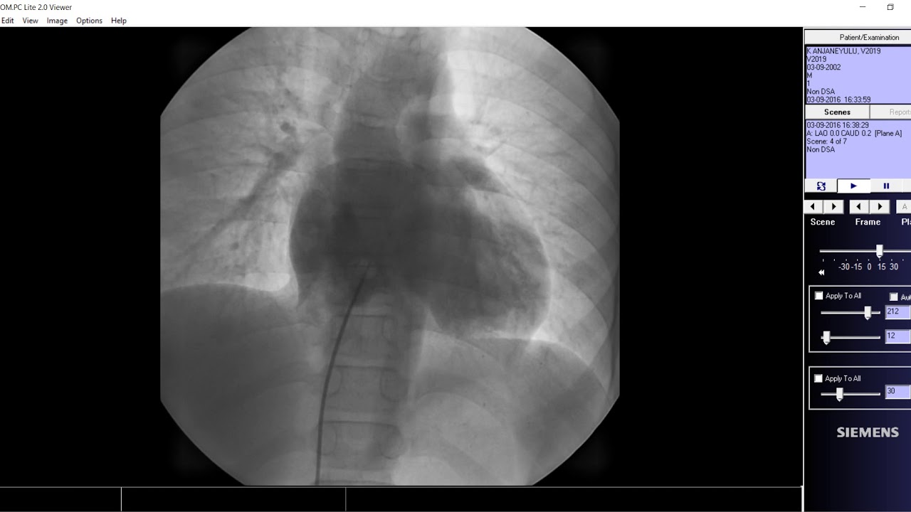 TRICUSPID ATRESIA catheterisation