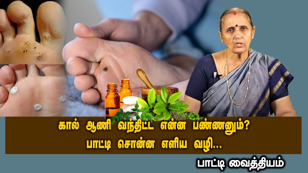 கால் ஆணி வந்திட்ட என்ன பண்ணனும் ? பாட்டி சொன்ன எளிய வழி ...