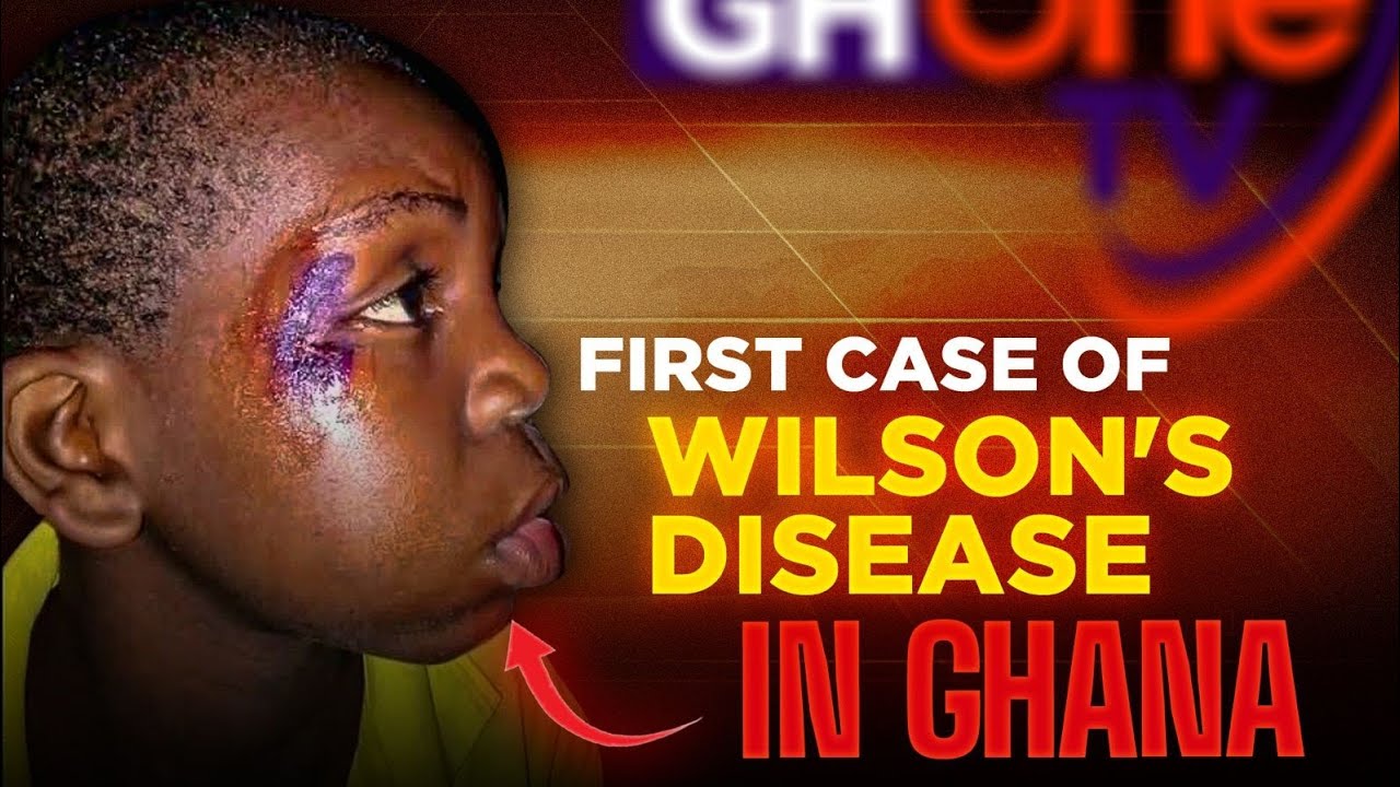 The Rare Case of Wilson's Disease, Is Ghana's Healthcare System Ready?