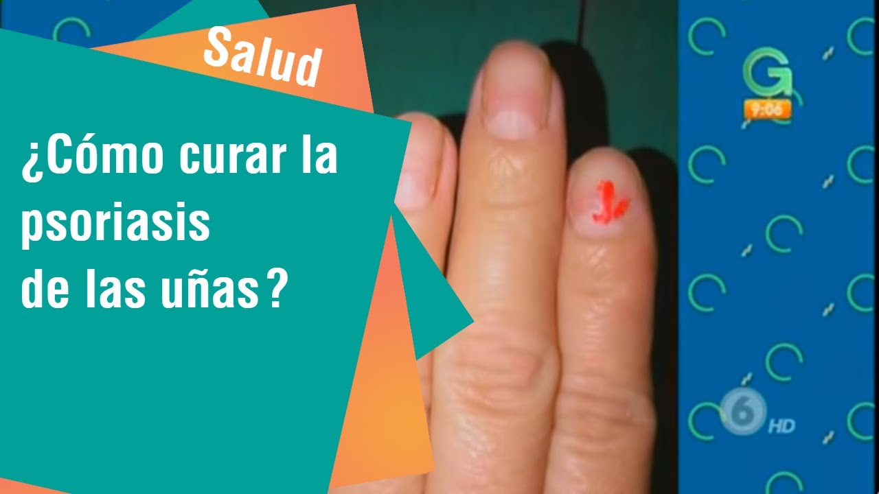 ¿Cómo curar la psoriasis de las uñas?