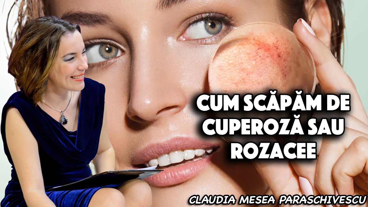 Cum scapam de cuperoza sau rozacee