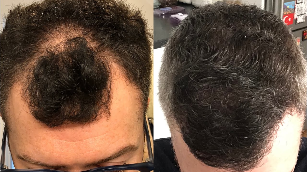 HAIR TRANSPLANT JOURNEY - 7 MONTH UPDATE - HLC Ankara