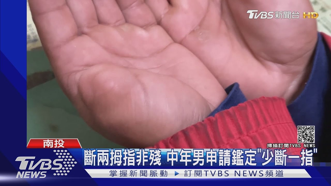 斷兩拇指非殘 中年男申請鑑定