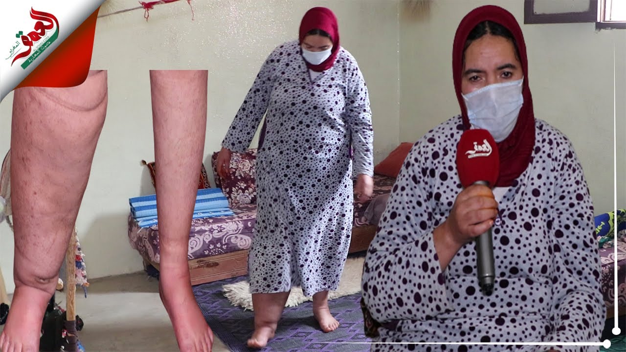 عيادة.. شابة مغربية تعاني من مرض نادر حول حياتها إلى جحيم تناشد المحسنين