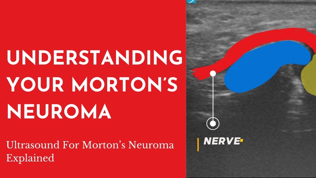 Ultrasound for Morton's Neuroma