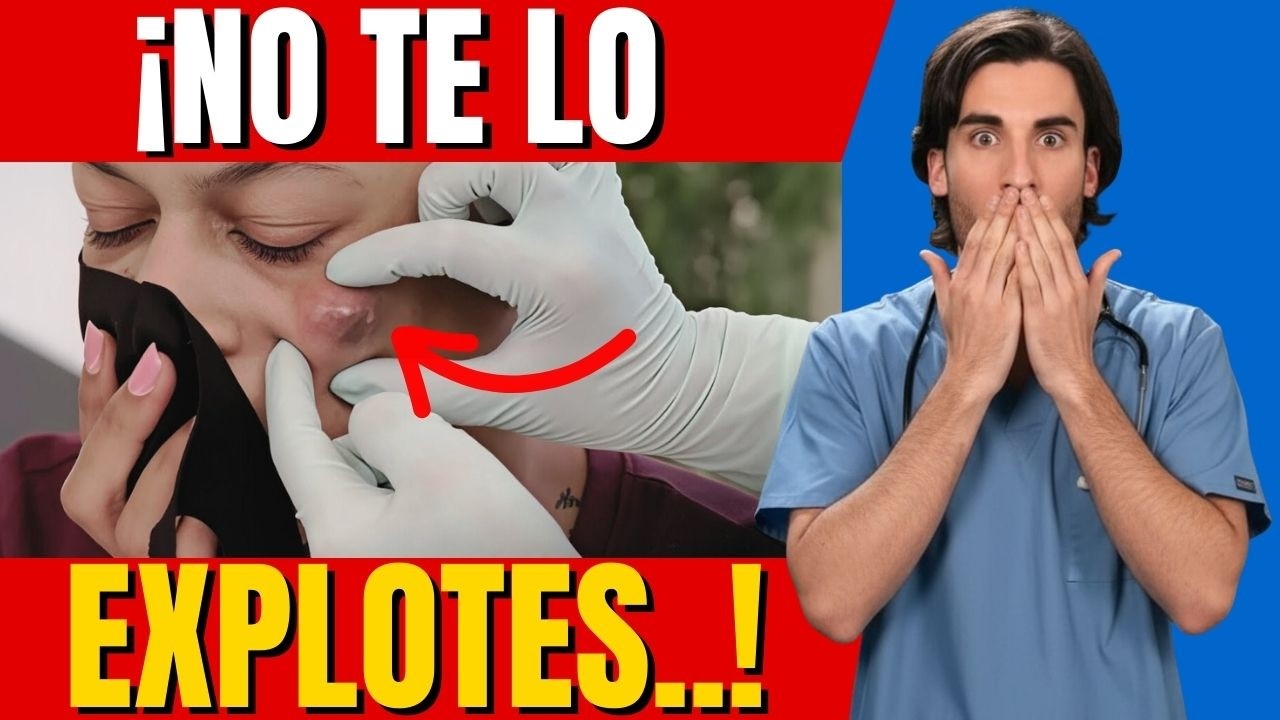¡Nunca las revientes! ¿Qué hay realmente adentro de una espinilla? | Dr. Emilio