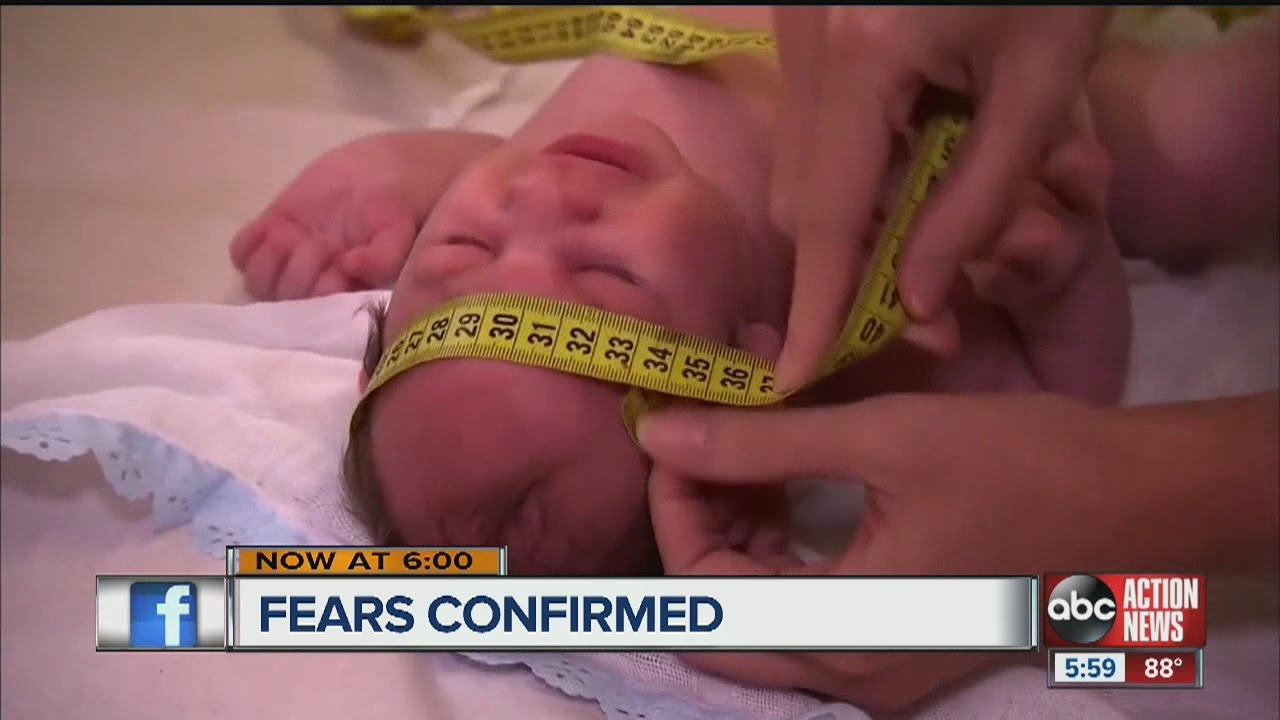 Infant born with microcephaly in Florida