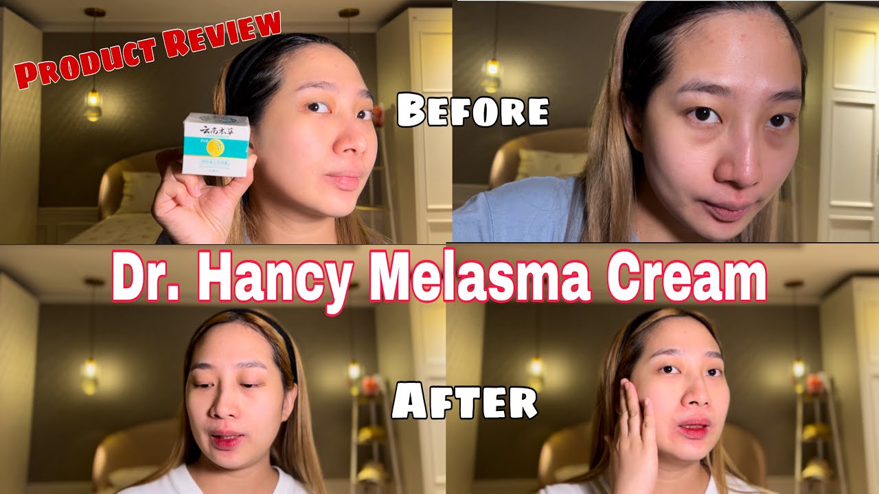 Dr. Hancy Melasma Cream Product Review #vlog #vlog3 #skincare #skincarereview #skincareproductreview
