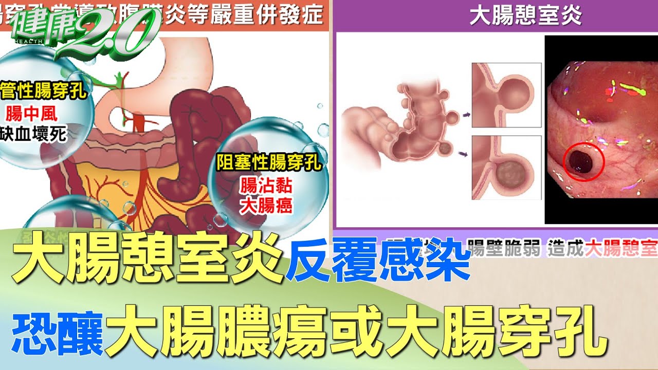 大腸憩室炎反覆感染 恐釀大腸膿瘍或大腸穿孔 健康2.0