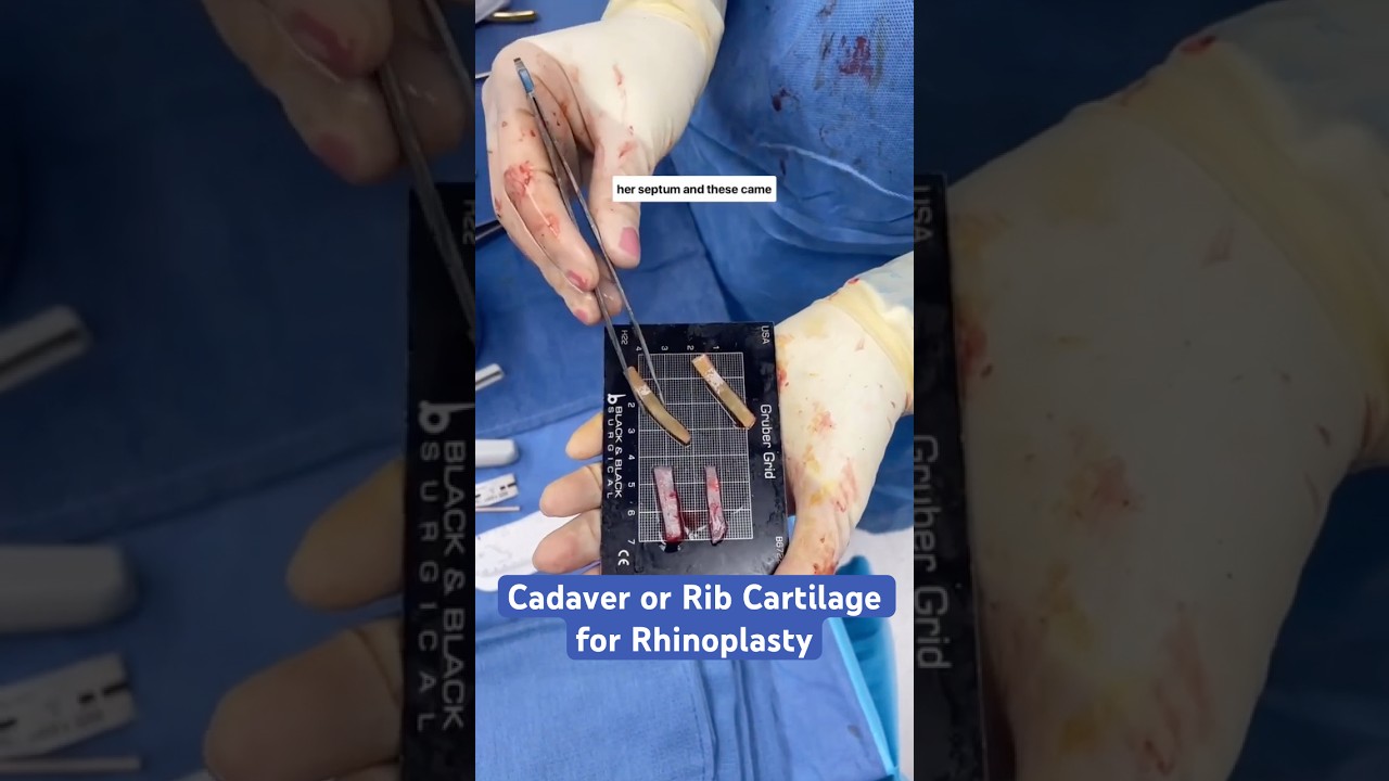 Cadaver Rib vs. Your Own: What We Use in Rhinoplasty - Face the Facts with Dr. Wang