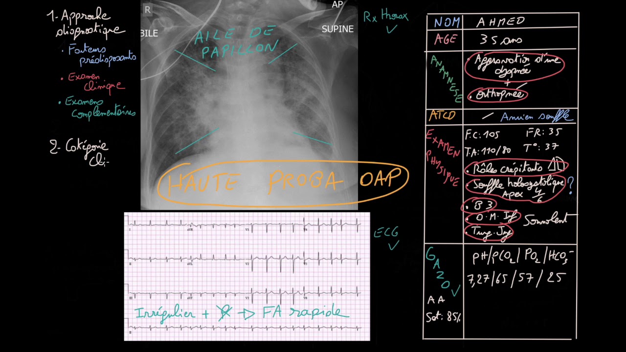 Insuffisance cardiaque aigue - Partie 2 - Docteur Synapse