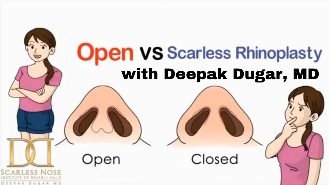 What is a Closed Rhinoplasty 