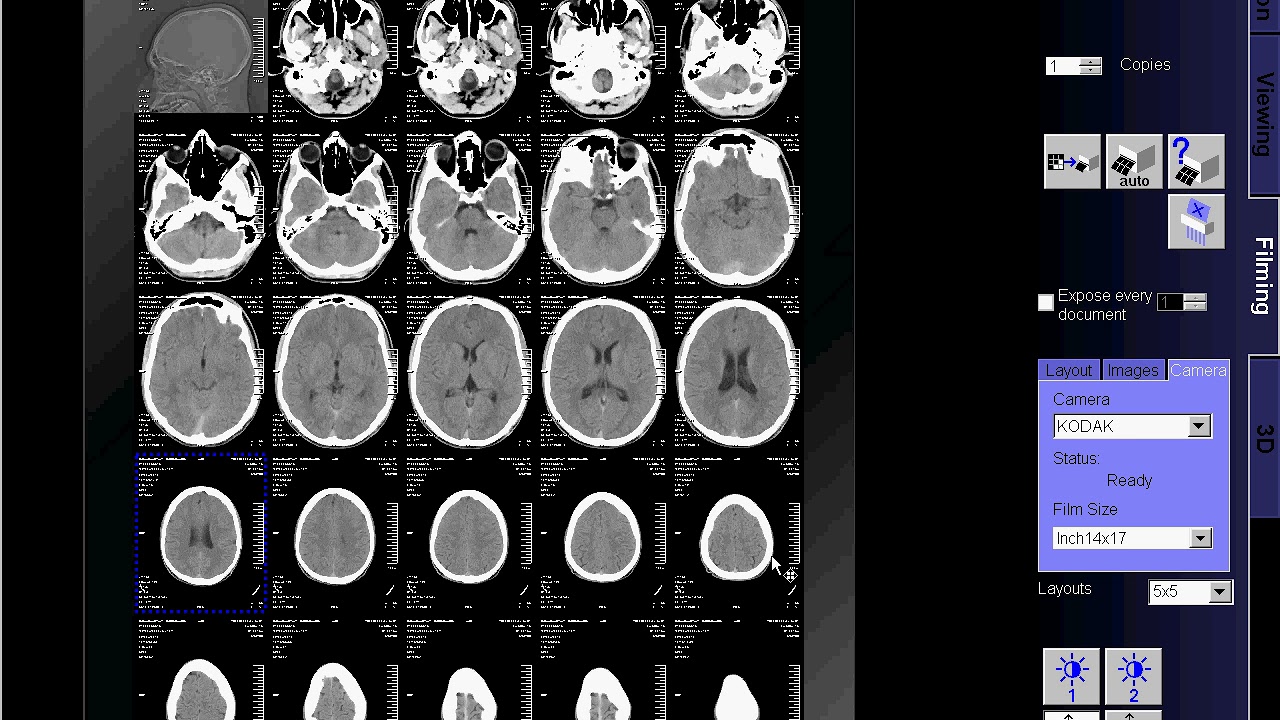 CT Scan of Brain fliming''SIEMENS''
