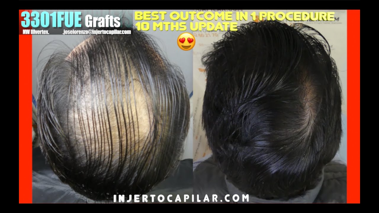 3301Grafts. NW IIIvertex. Best/amazing med/surgical outcome in 5 months.10 mths update.2969/2023