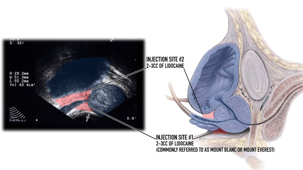 Modified Periprostatic Nerve Block Procedure