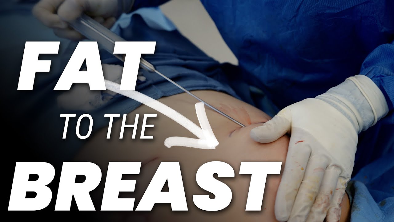 Fat Grafting vs. Implants: Natural Breast Enhancement