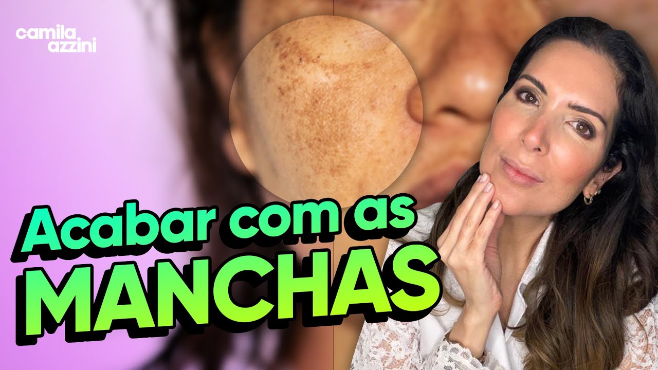Melasma no rosto: o que fazer para clarear