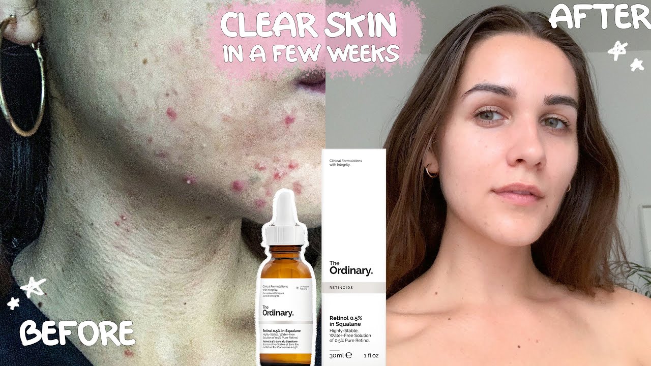 The Ordinary skincare CLEARED MY FACE for good! ACNE OUT (skincare update)