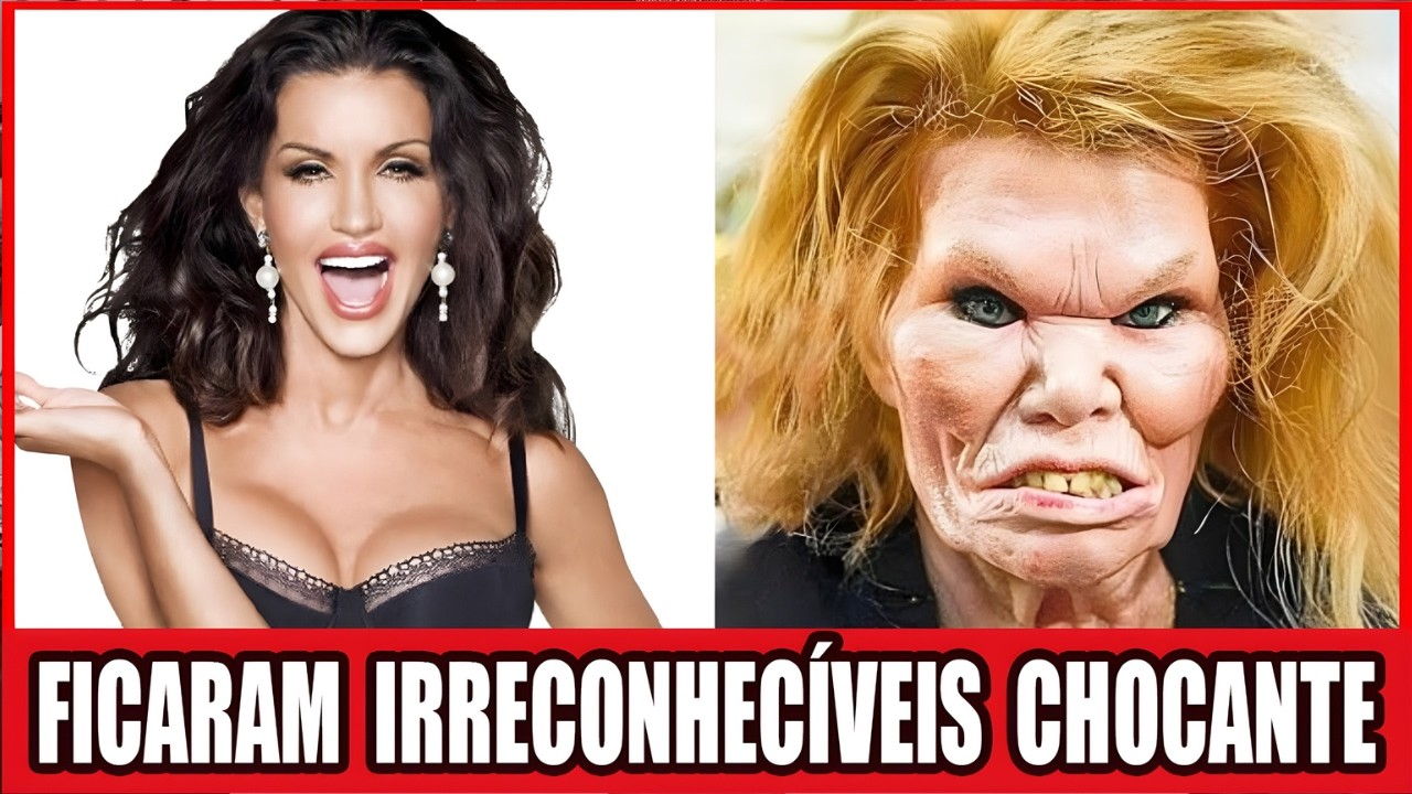 10 Celebridades De Hollywood Que Arruinaram O Rosto Com Cirurgia Plástica | Antes E Depois 2026