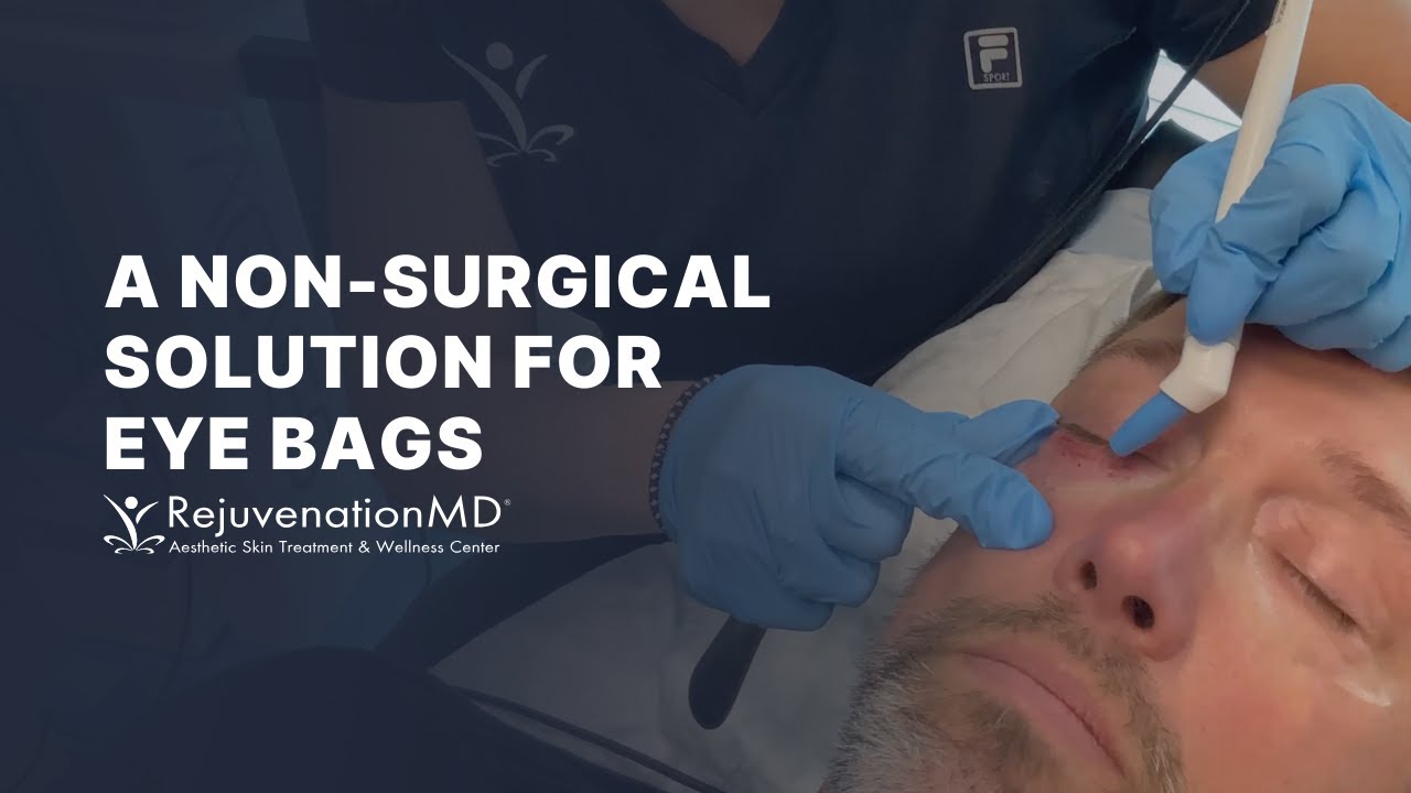 Eliminate Under Eye Bags with Agnes RF