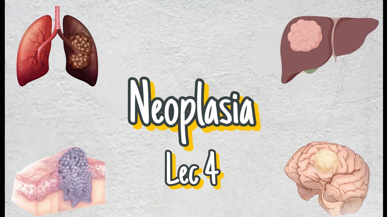 Neoplasia-Lecture 4(properties of cancer cell-carcinogens-clinical features and diagnosis)