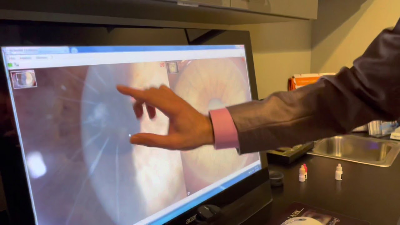 Corneal Scars, Keratoconus, Radial Keratotomy Complications Corrected for WorldWide Patients
