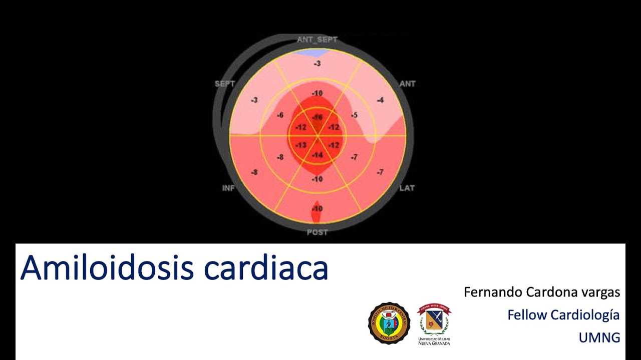Amiloidosis cardiaca, diagnostico fácil y rápido