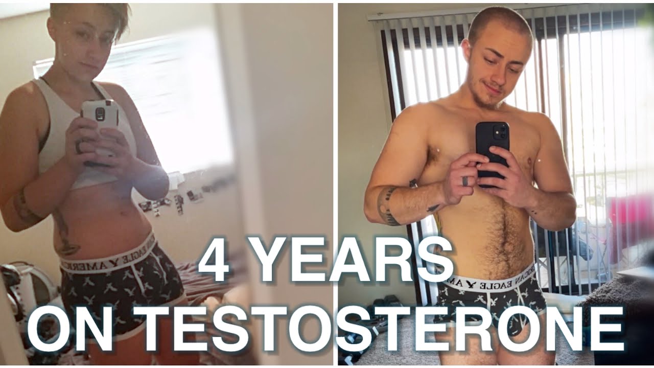 FTM: 4 years on Testosterone Comparison