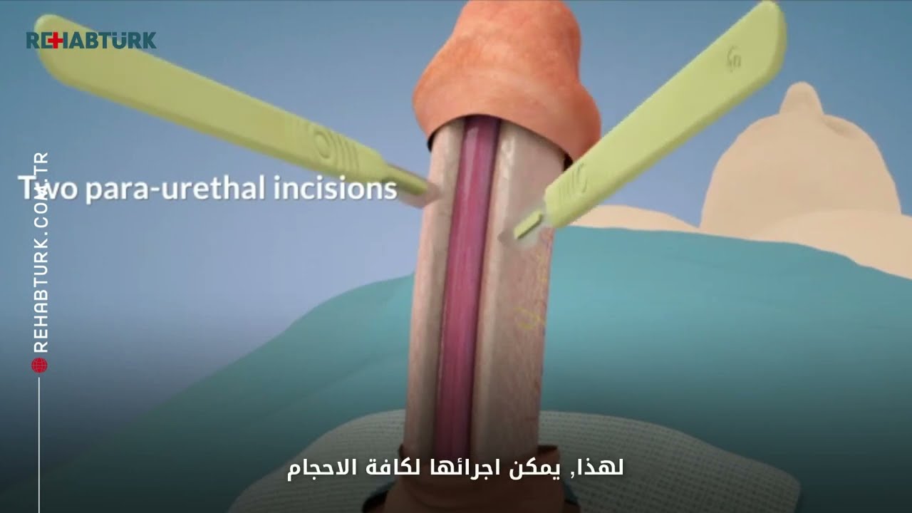 عملية تكبير القضيب بقطع الاربطة