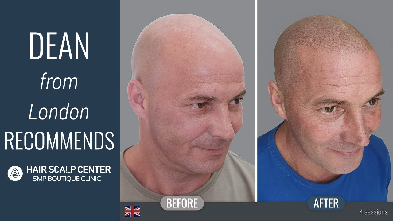 Dean's testimonial on how his SMP treatment at Hair Scalp Center in Bangkok changed his life