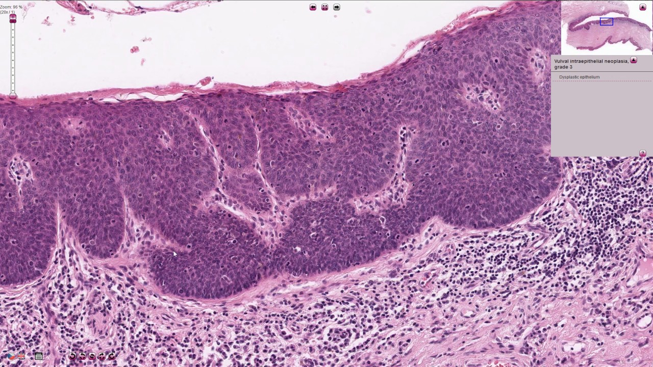Vulvar Intraepithelial Neoplasia (U-VIN) Histopathology