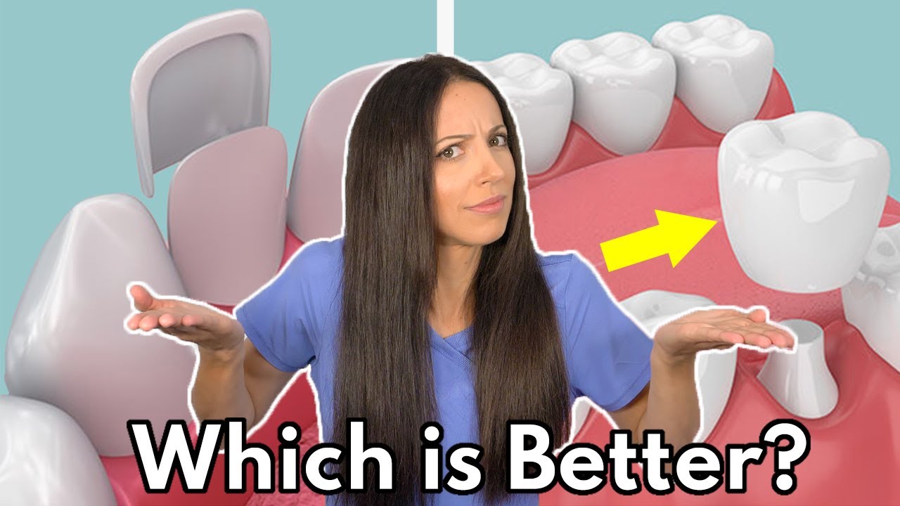 Dental Veneers vs. Crowns | Which is Better & What's the Difference