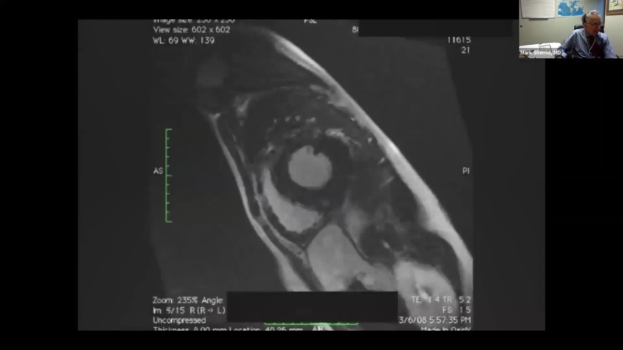 Hypertrophic Cardiomyopathy is Suddenly A Highly Treatable Condition