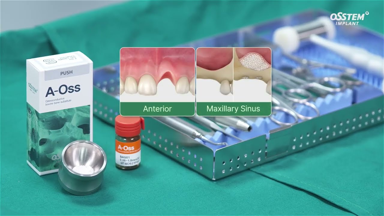 A-Oss: Bone graft with excellent osteoconductivity & volume stability | English