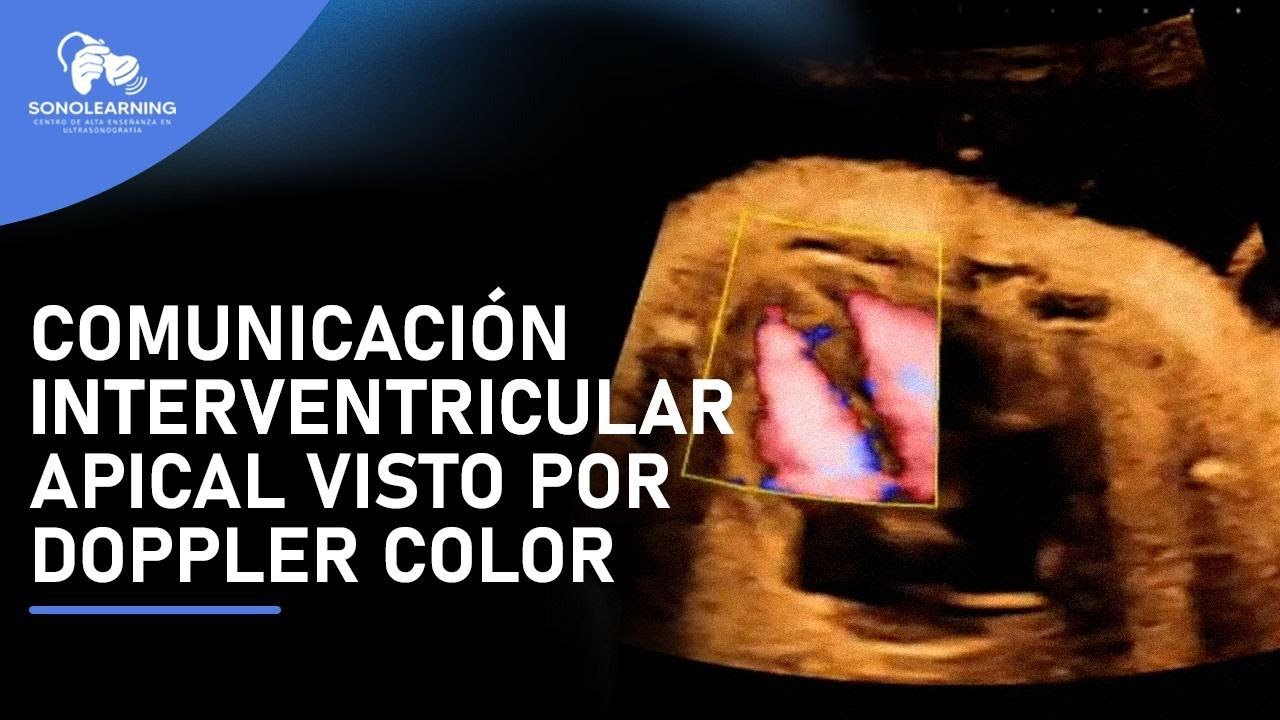 CIV APICAL #corazon #feto #ense&ntilde;anza #ultrasound #obstetricia #embarazada #fetalmedicine