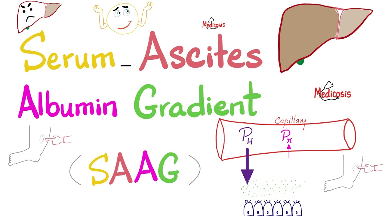 Serum Ascites Albumin Gradient (SAAG) | Peritoneal Effusion | Lab 🧪