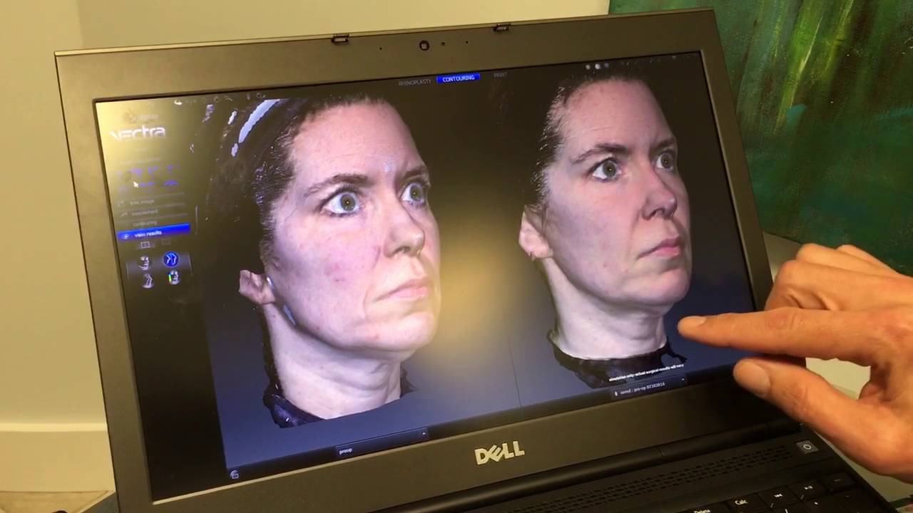Cheek Challenge 1 Year Follow Up Restylane Lyft vs Voluma Dr Weiner