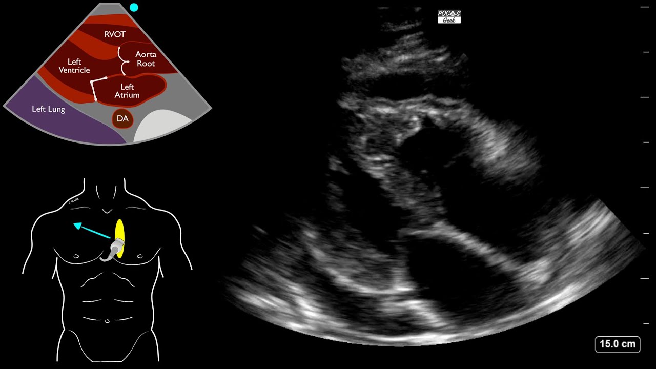 Is this pericardial tamponade?